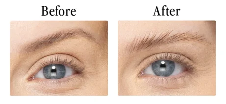 Before_After_Across_brows_2023_BrowLift_2.jpg